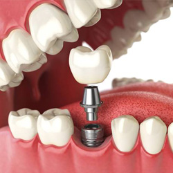 Zubní implantáty současnosti