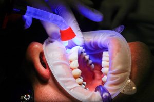 Zubní implantáty a jejich nasazování